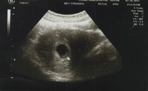 怀孕1到8个月的图片