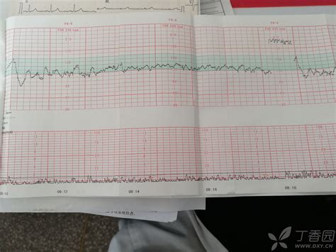 胎动fhr上升时间什么意思