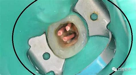 請問你們這里做根管治療時使用橡皮障嗎