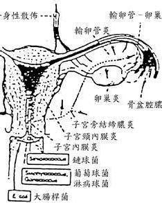 输卵管炎和附件炎是一回事吗?