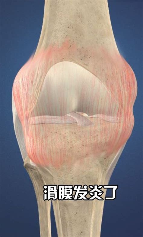 脚踝扭伤引起关节炎怎么治疗