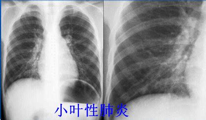 鸡气囊炎发病症状是什么样