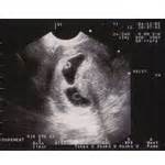 孕5周孕囊见卵黄未见胎芽