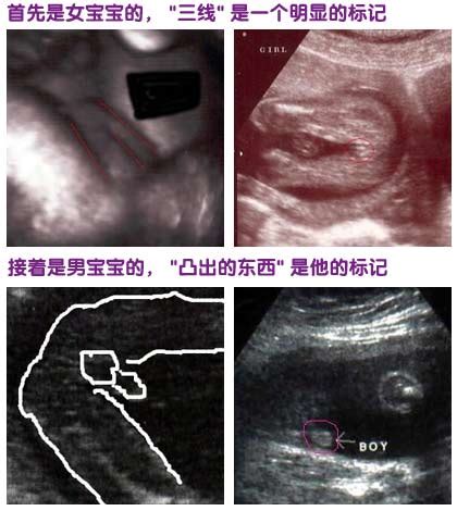怀孕三个月双胞胎b超图
