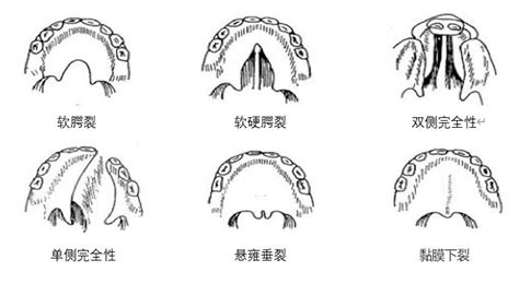 唇腭裂和兔唇的区别图片