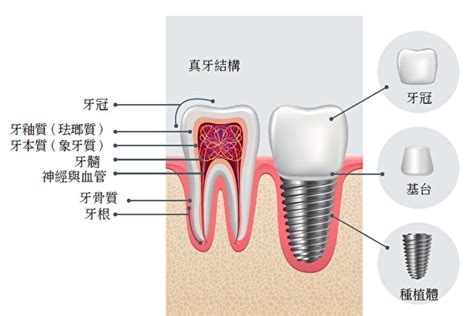 种牙全部费用