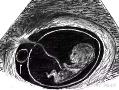 孕囊变小未见卵黄囊和胎芽