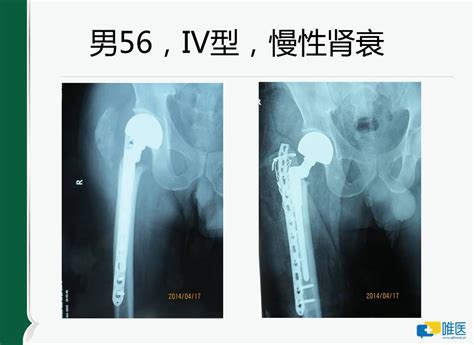 股骨颈三个月锻炼视频