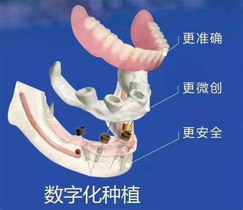 华西医院种一颗牙贵不贵