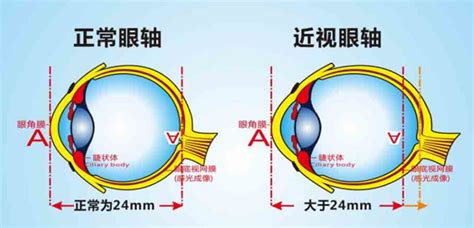 叶黄素对近视有用吗