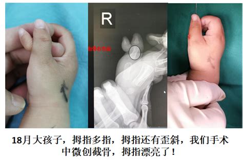 四维能看出孩子手脚畸形吗