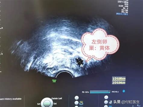 监测排卵需要去查是否排出了吗