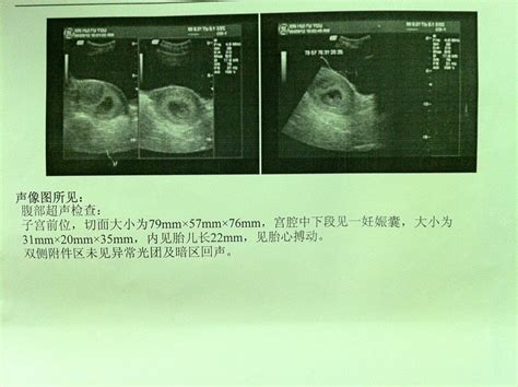 怀孕胎儿胎心率150