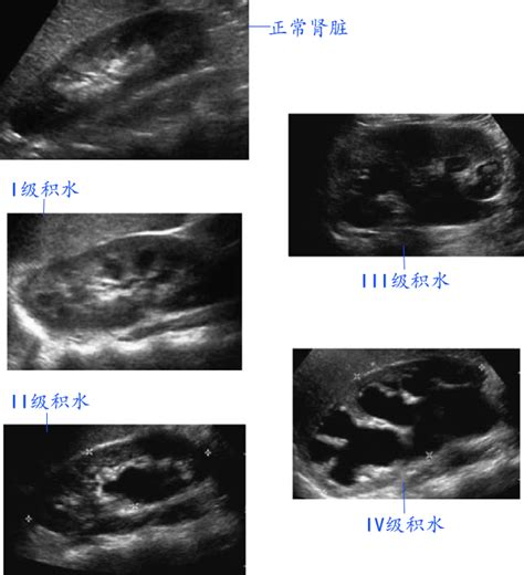 胎儿重复肾的超声诊断表现