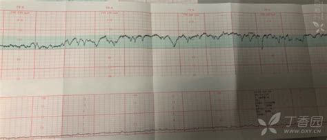 胎心报告基线变异中度变异正常吗