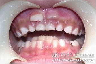 宝宝换的第一颗牙齿怎么处理