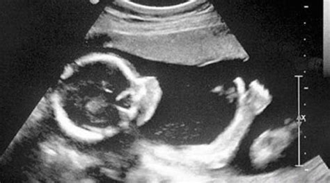 胎儿性别鉴定的方法