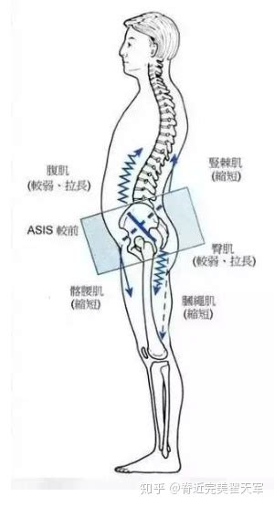 骨盆前倾对身体的危害是什么