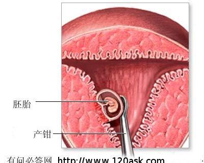 无痛清宫要几天