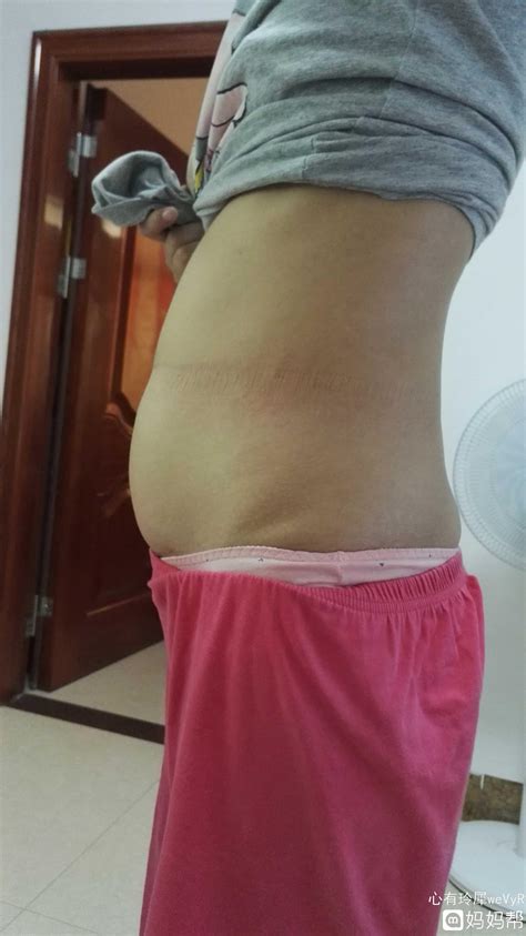20周双胞胎孕妇肚子超大，为保命医生竟在腹中直接做手术