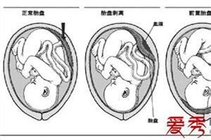 孕30周胎盘偏大2级