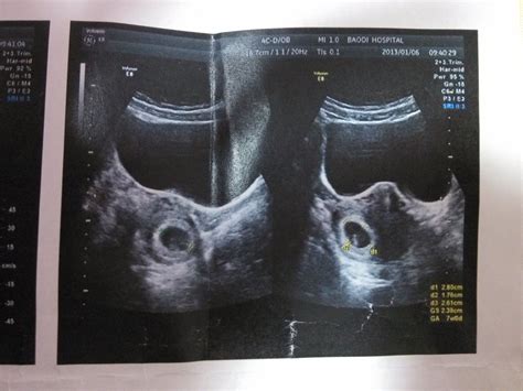 怀孕15周肚子左右鼓包是胎动吗