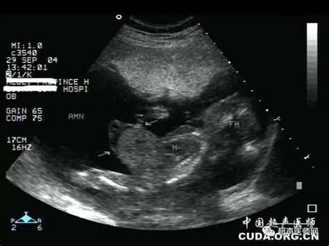 孕8周胎儿真实图片