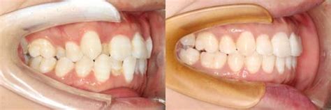 口腔牙齿问题多对孕期有影响吗