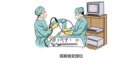 胸交感神經(jīng)切除