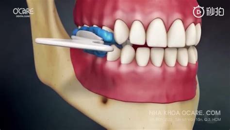 临时假牙树脂材料有毒吗