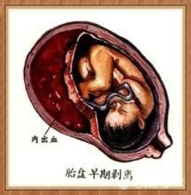 胎盘厚度1.27cm