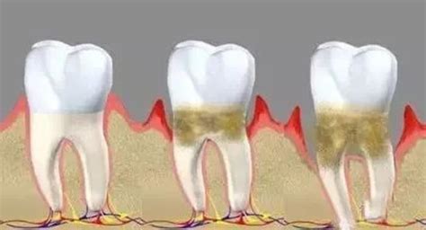戴假牙会引起牙齿松动吗