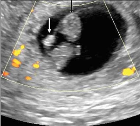 孕6周卵黄囊未见胚胎回声正常吗