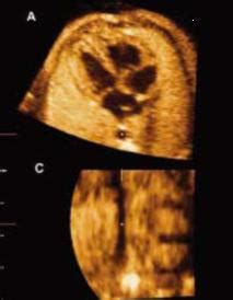 30周胎儿心脏有小缺口