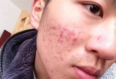 达英35治痤疮多久有效