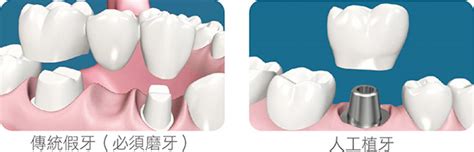 树脂假牙可以长期放在嘴巴里吗