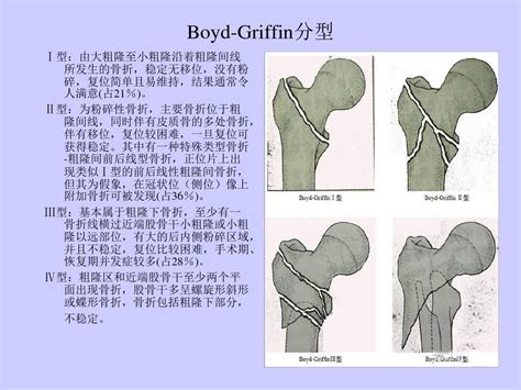 做完四维股骨3.87cm正常吗