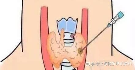 甲状腺结节吃什么药效果好