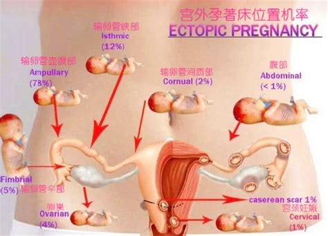 左卵巢旁囊性结构宫外孕