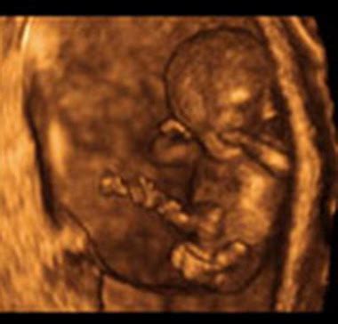 从早孕b超单可以看出生男生女