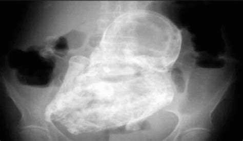 二胎想怀男孩孕前准备