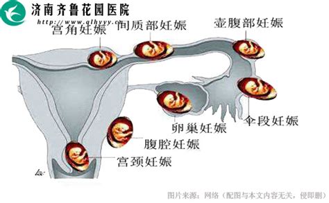 宫外孕可以防止吗