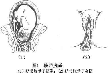 孕妇为什么会胎膜早破?