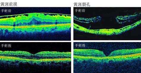 高度近视离致盲有多远