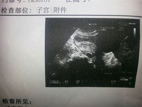 怀孕48天b超没听见胎心