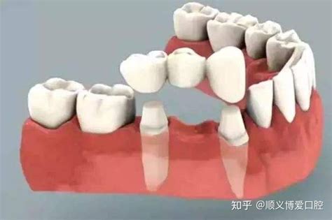 假牙修复有哪几种