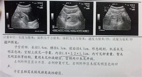 hcg隔天翻倍1.85倍正常吗