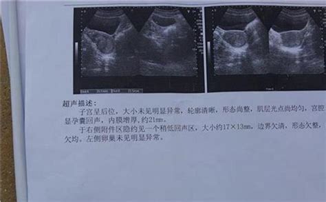 怀孕43天胎囊发育