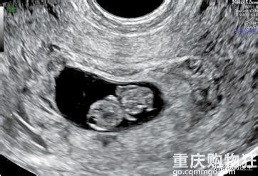 怀孕八周b超显示图片