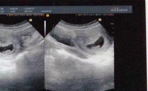 怀孕10周双胞胎图片